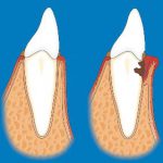 Grafik zu Gingivitis und Parodontitis