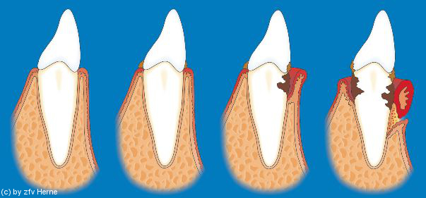 Grafik zu Gingivitis und Parodontitis